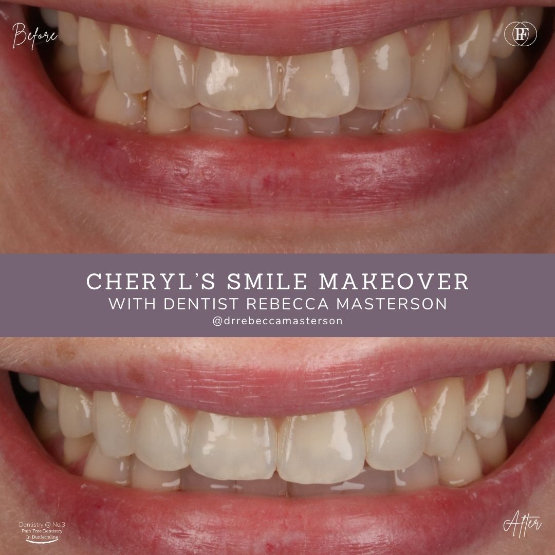 Cheryl's Smile Story | Dentistry @ No.3 & Century House