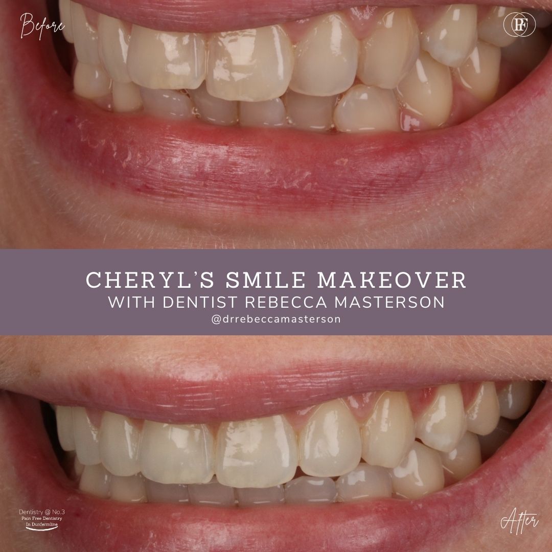 Cheryl's Smile Story | Dentistry @ No.3 & Century House
