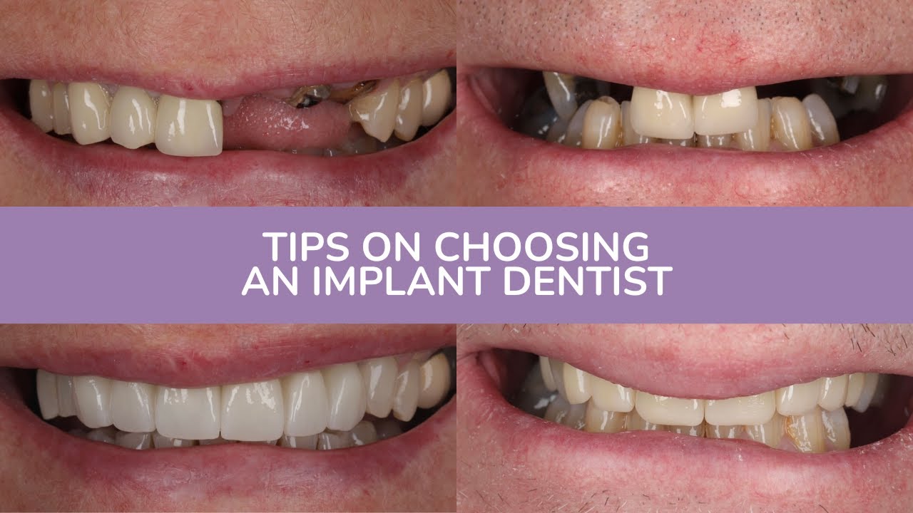 dental implants in Dunfermline