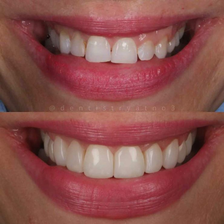 Transforming Smiles