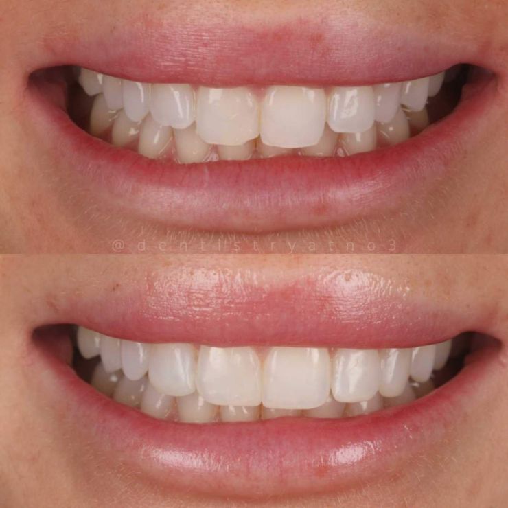 Transforming Smiles