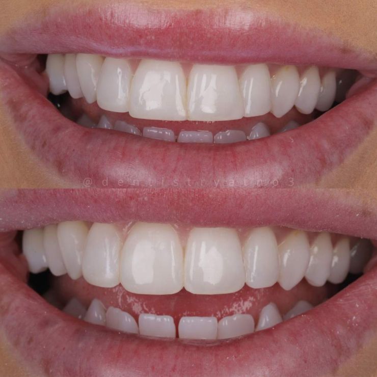 Transforming Smiles