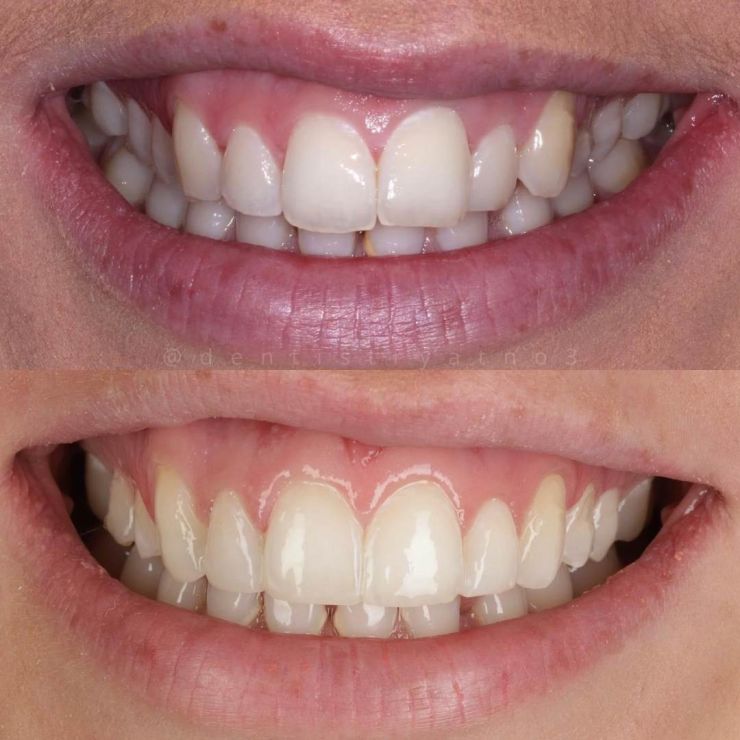 Transforming Smiles